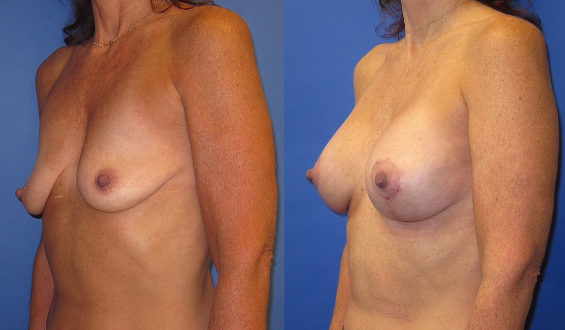 This is a photo of a woman before and after breast lift with implants.. 