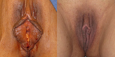 Photo before and after labiaplasty surgery.
