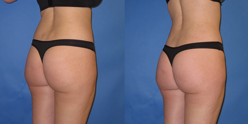 Photo of a woman before and after liposuction.