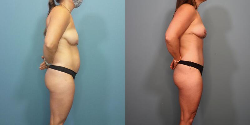 Photo of a woman before and after a mommy makeover with breast lift and a tummy tuck.