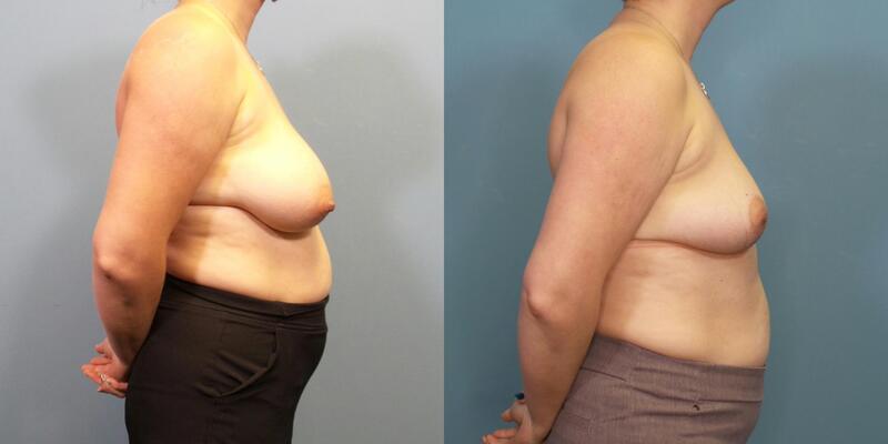 Photo of a woman before and after breast reduction surgery.
