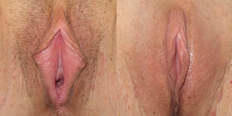 Photo of a woman before and after labiaplasty. 
