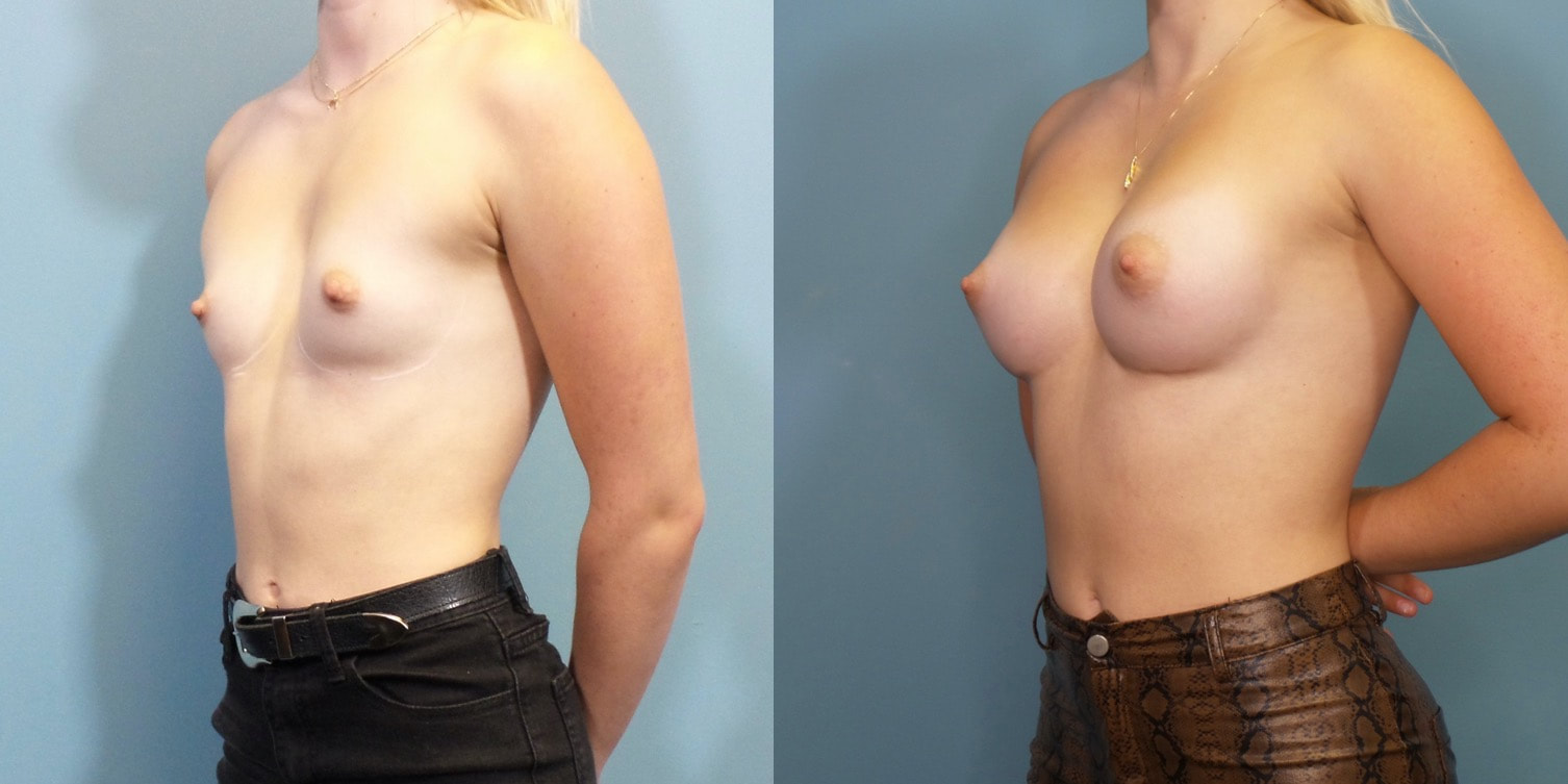 Young woman before and after breast augmentation.