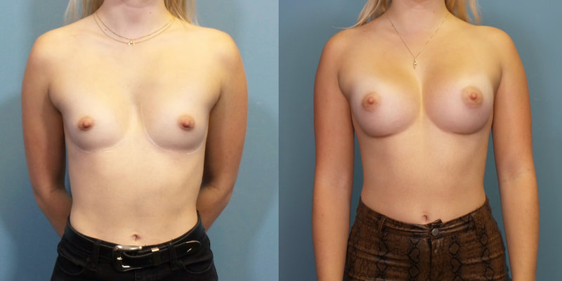 Young woman before and after breast augmentation.