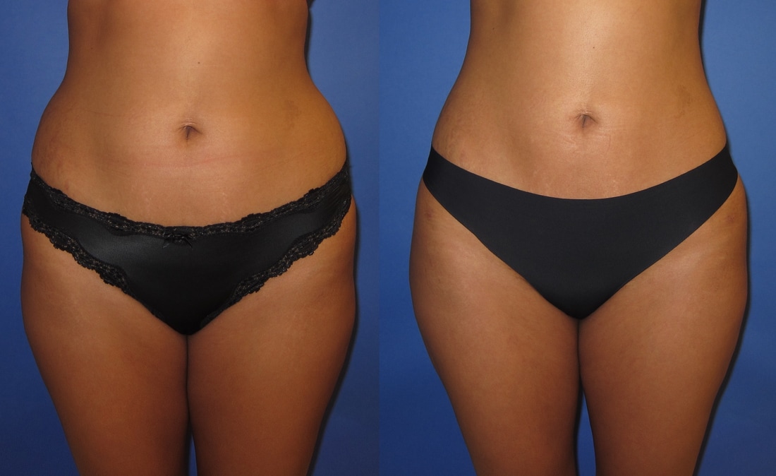 Liposuction Before and After Photos - Portland Plastic ...