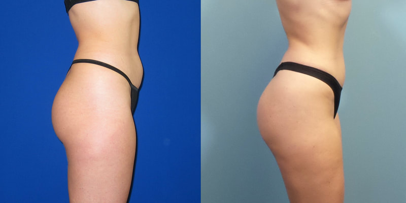 Photo or a woman before and after Brazilian butt lift. 