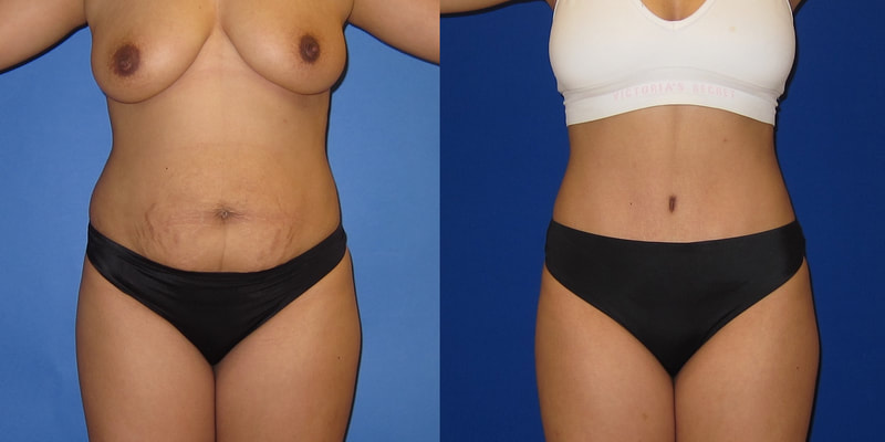Photo of a woman before and after a tummy tuck.
