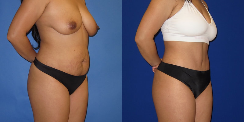 Photo of a woman before and after a tummy tuck.