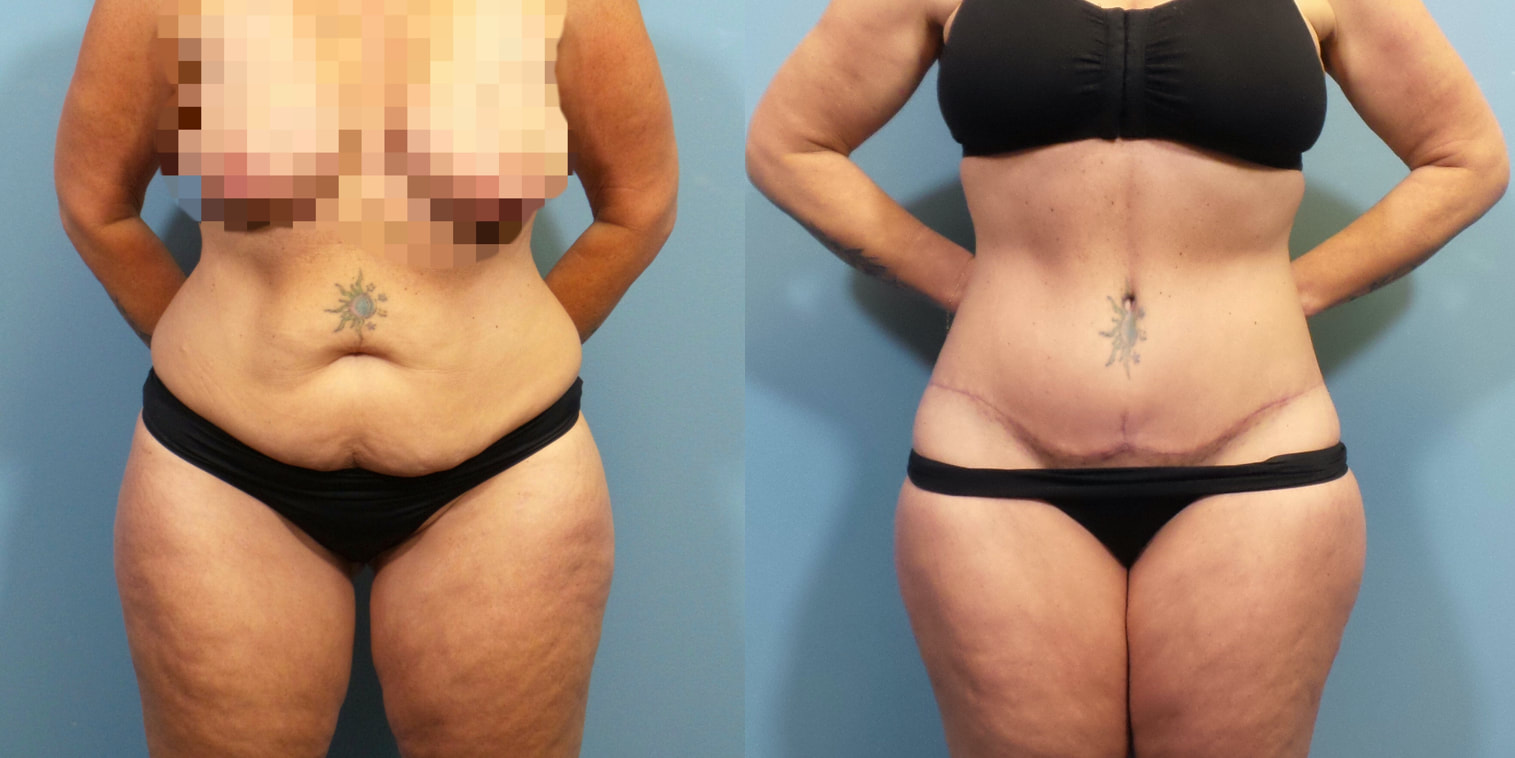 Photo of a woman before and after lipo 360 and a 270 degree tummy tuck.