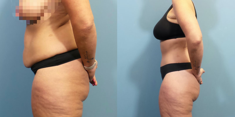 Photo of a woman before and after lipo 360 and a 270 degree tummy tuck.
