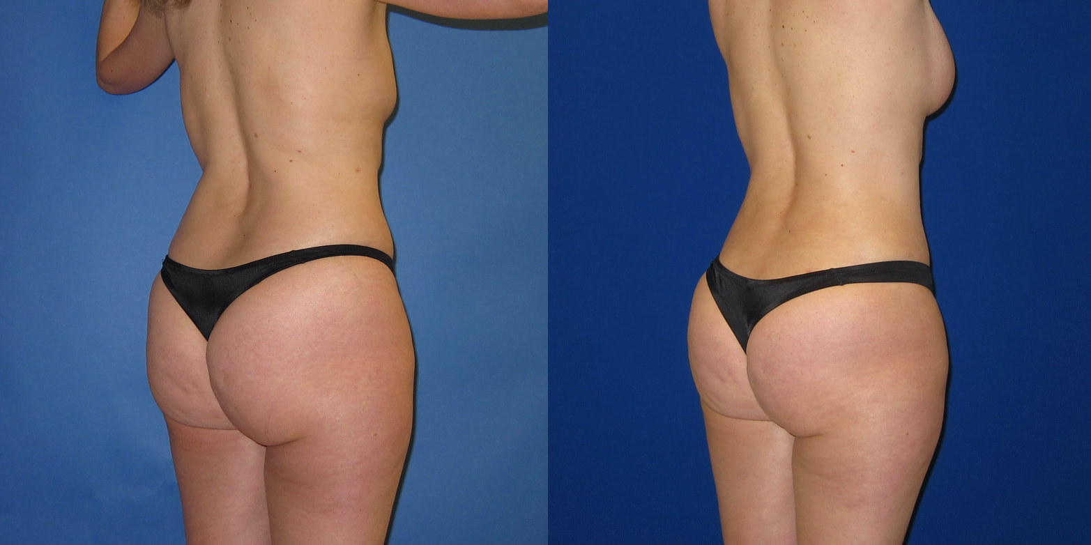 Photo of a woman before and after love-handle liposuction.