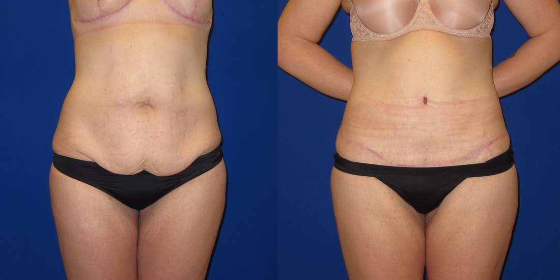 before and after photo of 270 degree tummy tuck with liposuction b orig