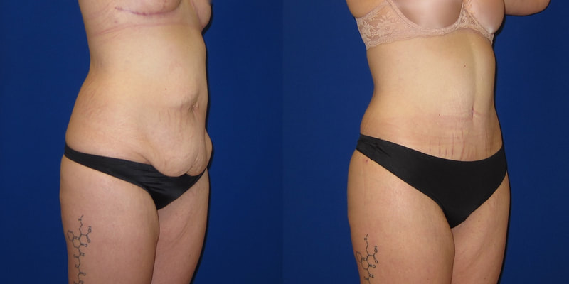 Photo of a woman before and after a tummy tuck with liposuction. 