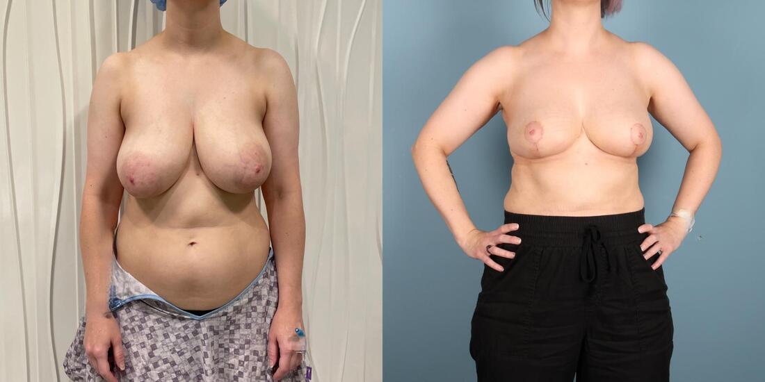 Photo of a woman before, and two months after, a double bra breast reduction.