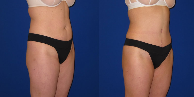 Photo of a woman before and after a tummy tuck. 