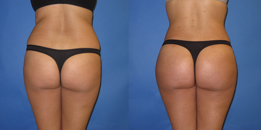 Before and after photo of a yound woman after liposuction of her waist and love handles with fat grafting to her buttocks. 