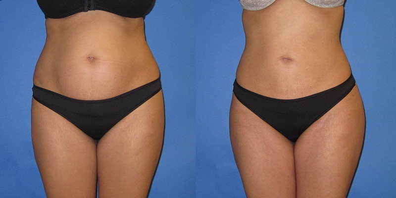 Photo or a woman before and after Brazilian butt lift. 
