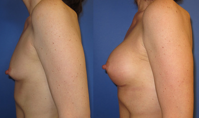 Photo or a woman before and after breast augmentation. 