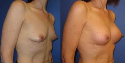 Photo or a woman before and after breast augmentation.