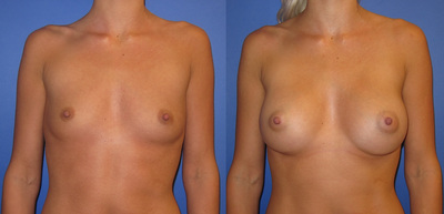 Photo or a woman before and after breast augmentation.