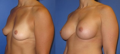Photo of woman before and after breast augmentation. 