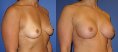 Photo of woman before and after breast augmentation. 