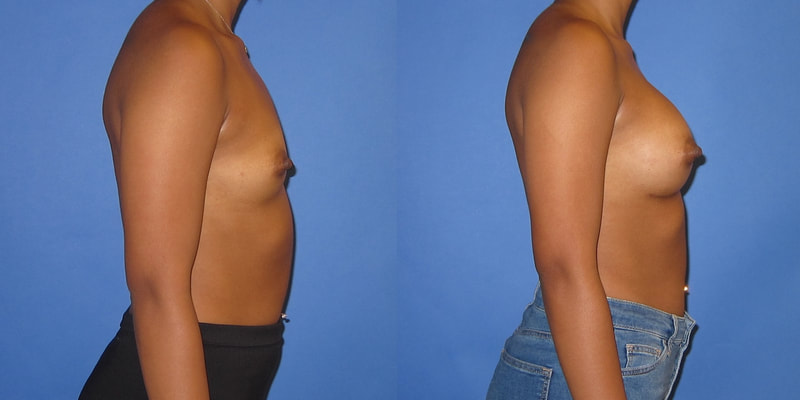 Breast augmentation before and after photo.