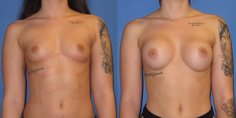 Photo of woman before and after breast augmentation.