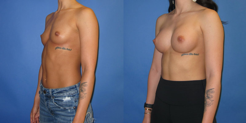 Photo of woman before and after breast augmentation.