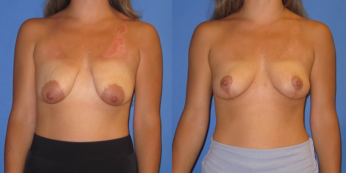 This is a photo of a young woman six weeks after full breast lift. 