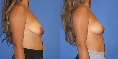 Photo of a woman before and after breast lift surgery.