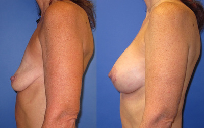 Photo of a woman before and after a breast lift with implants.