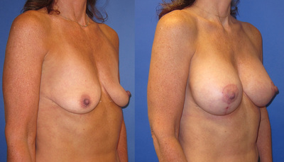 Photo of a woman before and after a breast lift with implants.