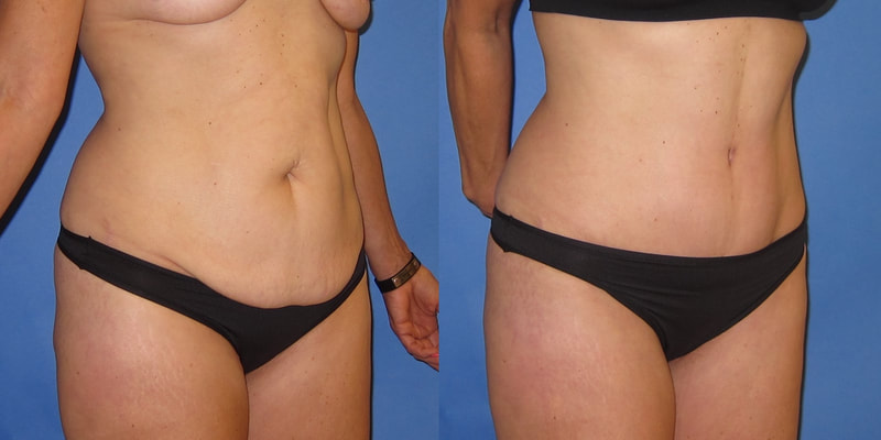Tummy tuck before and after. 