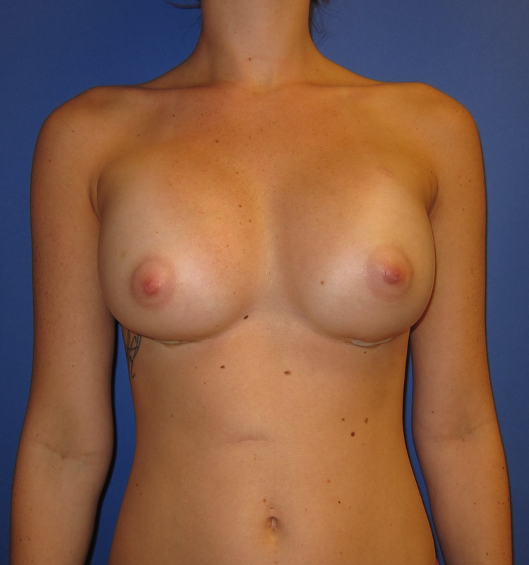 The first day after breast augmentation surgery. 