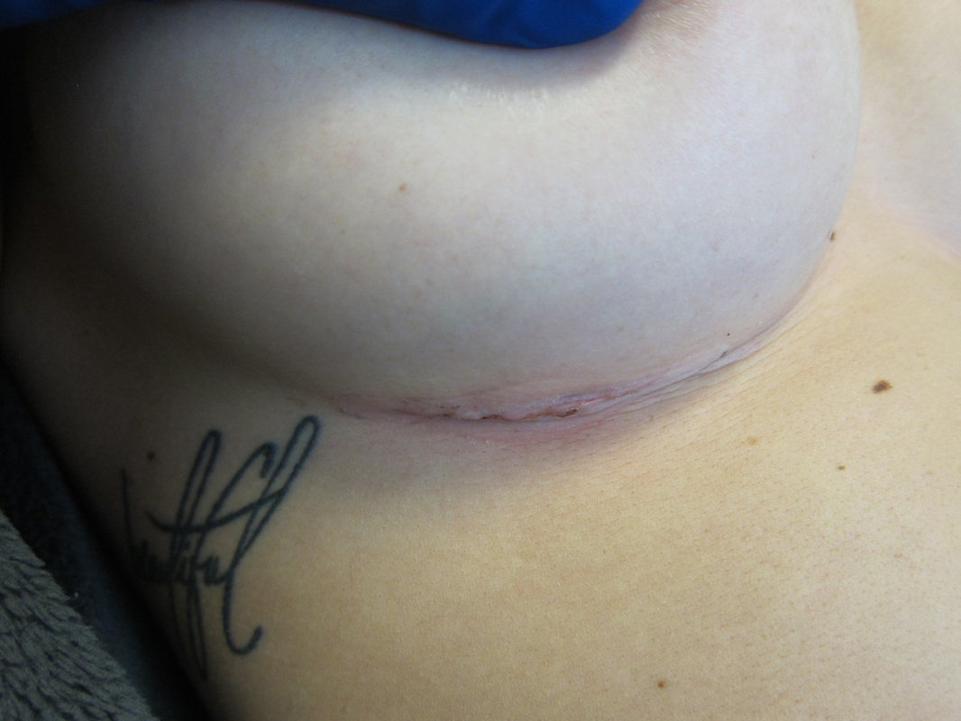 The incision after breast augmentation hides in the crease below the breast. 