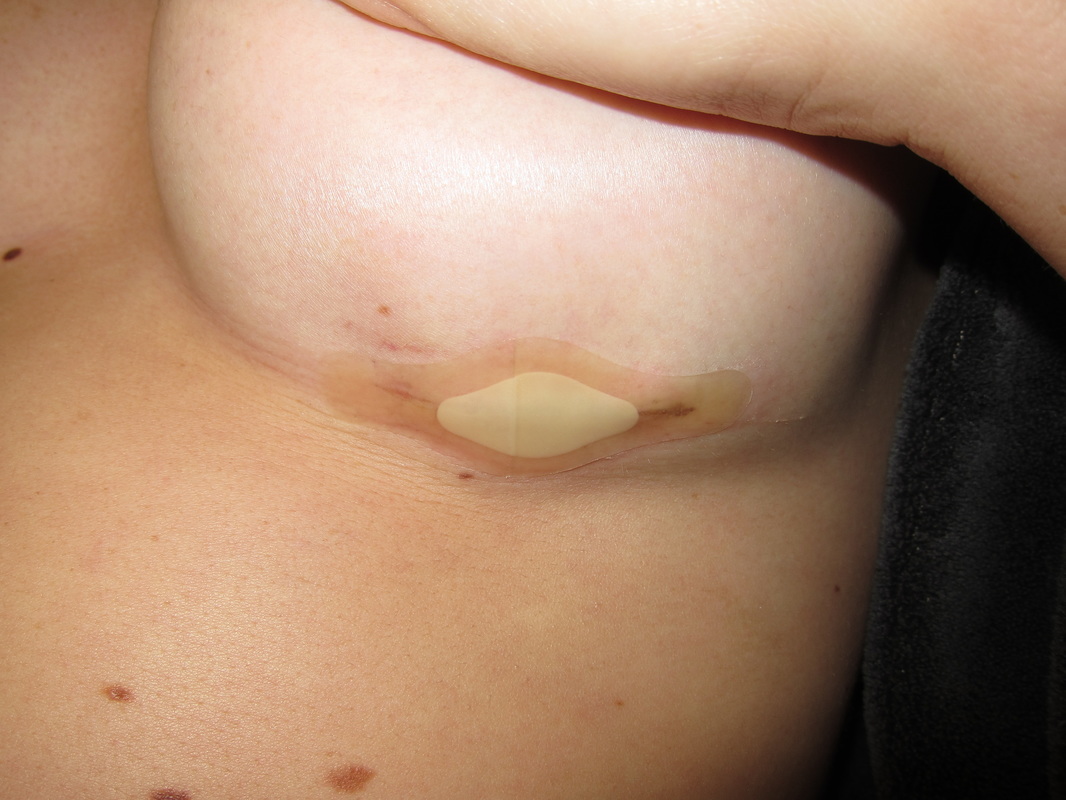 Breast augmentation incision covered with a band-aid. 