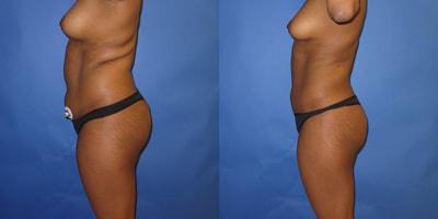 Photo of a woman before and after liposuction.