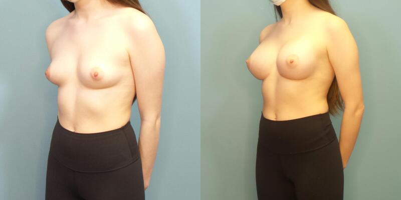 Photo of a patient before and after breast augmentation.