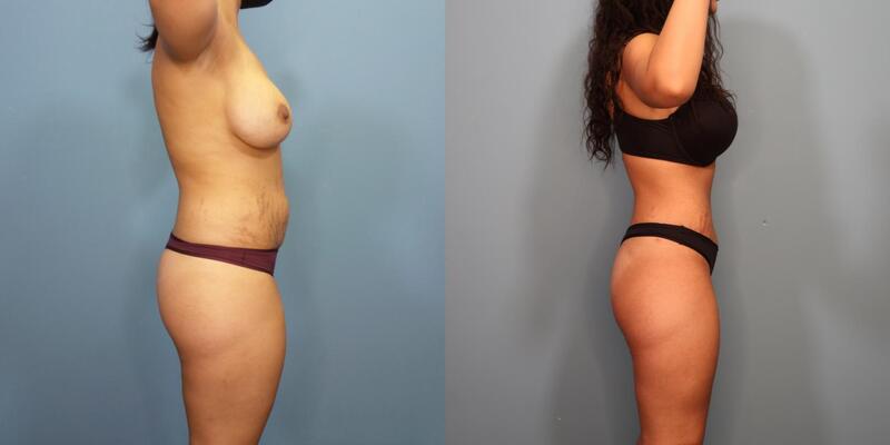 Photo of a woman before and 1.5 years after a tummy tuck with lipo 360.
