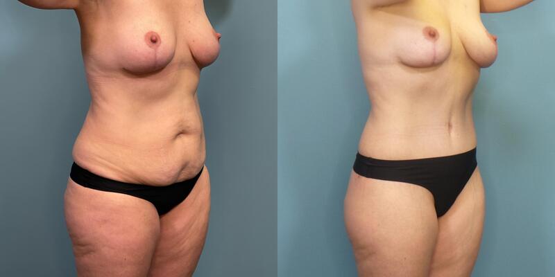Photo of a woman before and 3 months after a 270 degree abdominoplasty with liposuction.