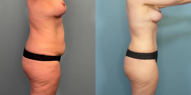 Photo of a woman before and 3 months after a 270 degree abdominoplasty with liposuction.