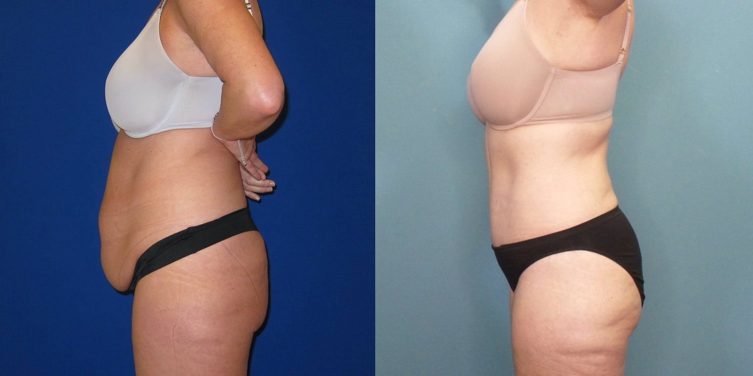 Photo of a woman before and after a 270 degree tummy tuck.