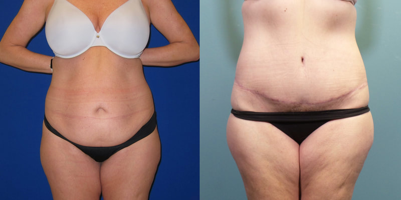 Photo of a woman before and after a 270 degree tummy tuck.