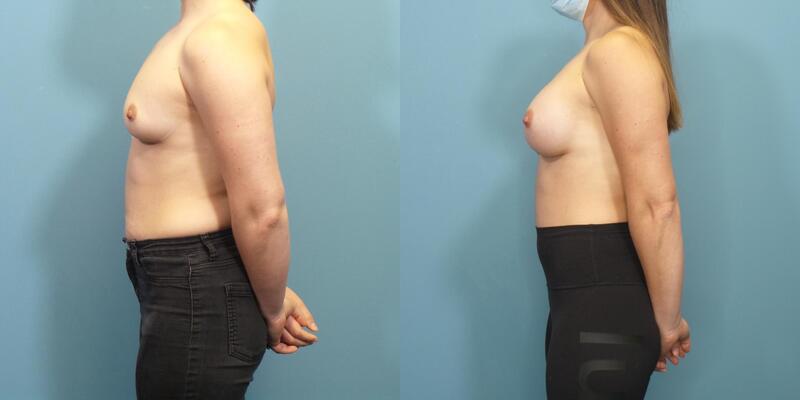 Photo of a woman before and after a breast augmentation procedure with Sientra 305 cc silicone breast implants.