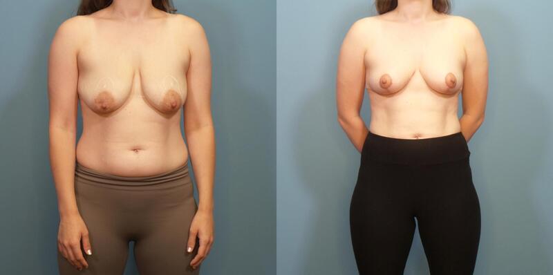 Photo of a woman before and after a breast lift with creation of internal bra.
