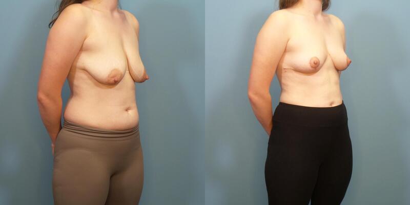 Photo of a woman before and after a breast lift with creation of internal bra.