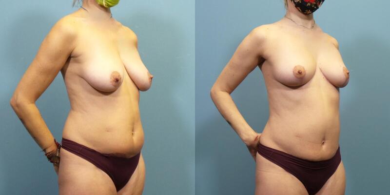 Photo of a woman before and after a breast lift with internal bra and abdominal liposuction.