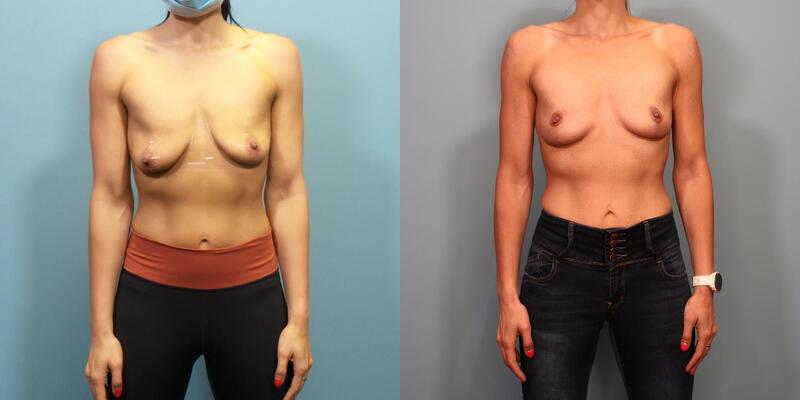 Photo of a woman before and after breast lift surgery.