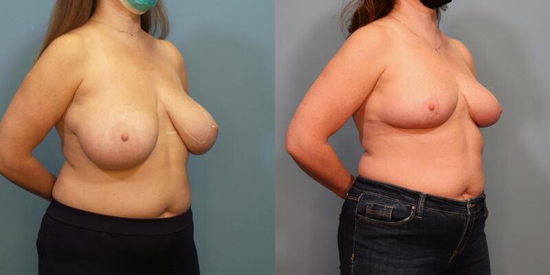 Photo of a woman before and after breast reduction surgery with internal bra.